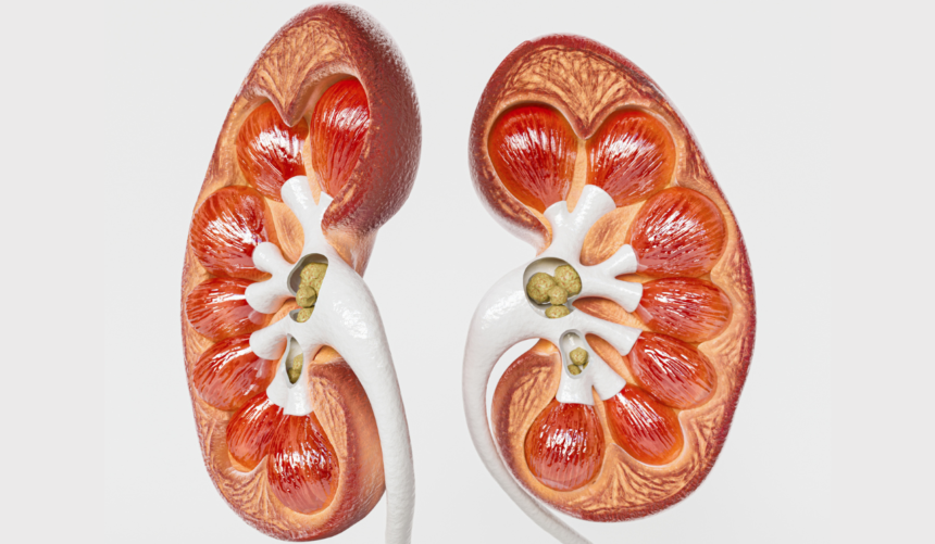 O excesso de açúcar e os riscos para a formação de pedras nos rins